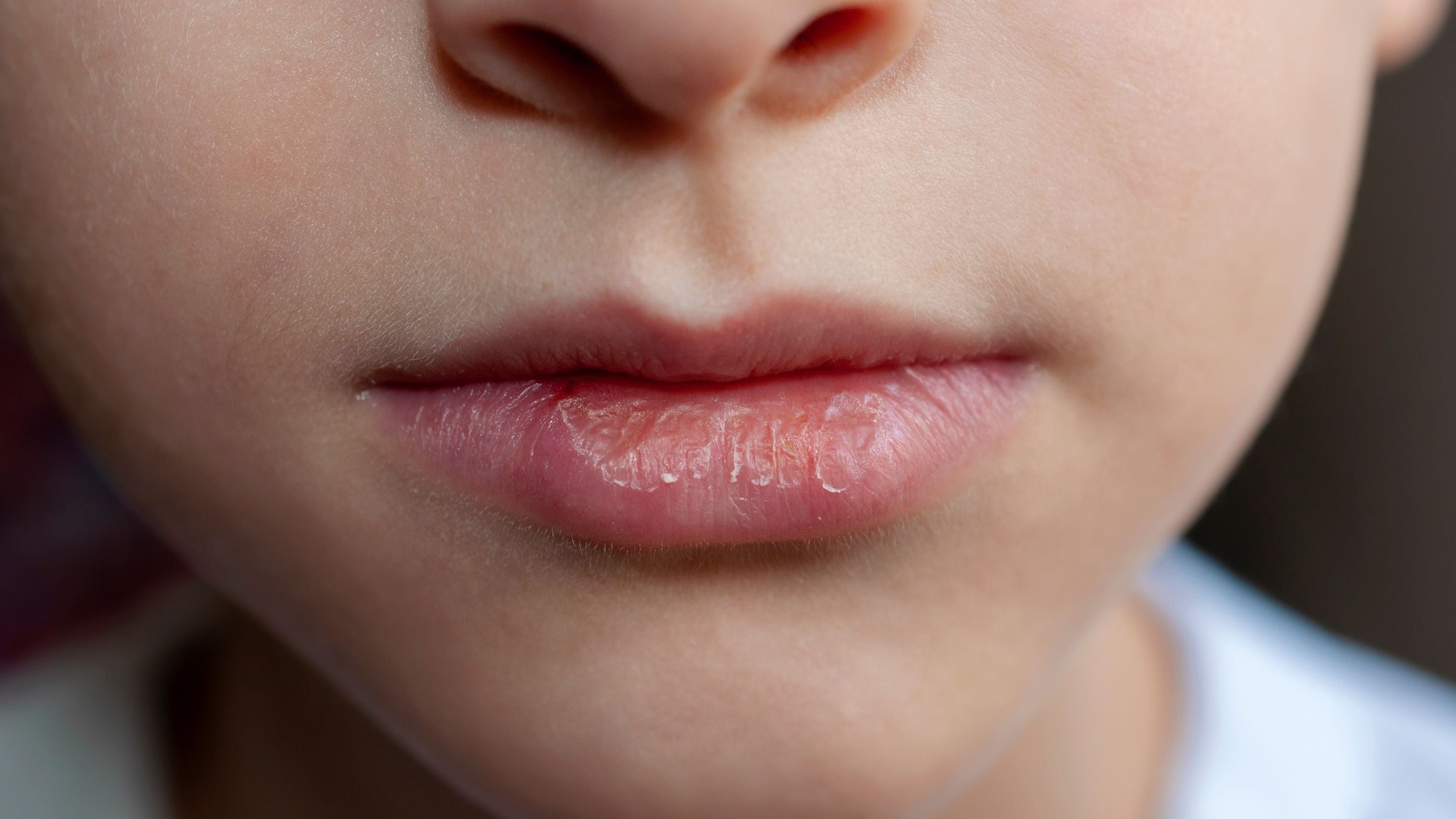 The Causes and Solutions to Dry, Chapped Lips