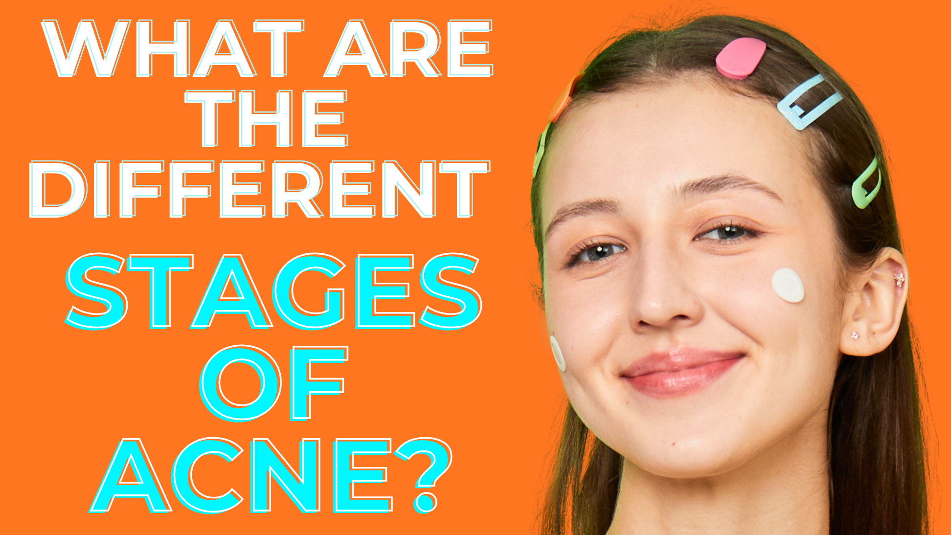 What are the different stages of acne?