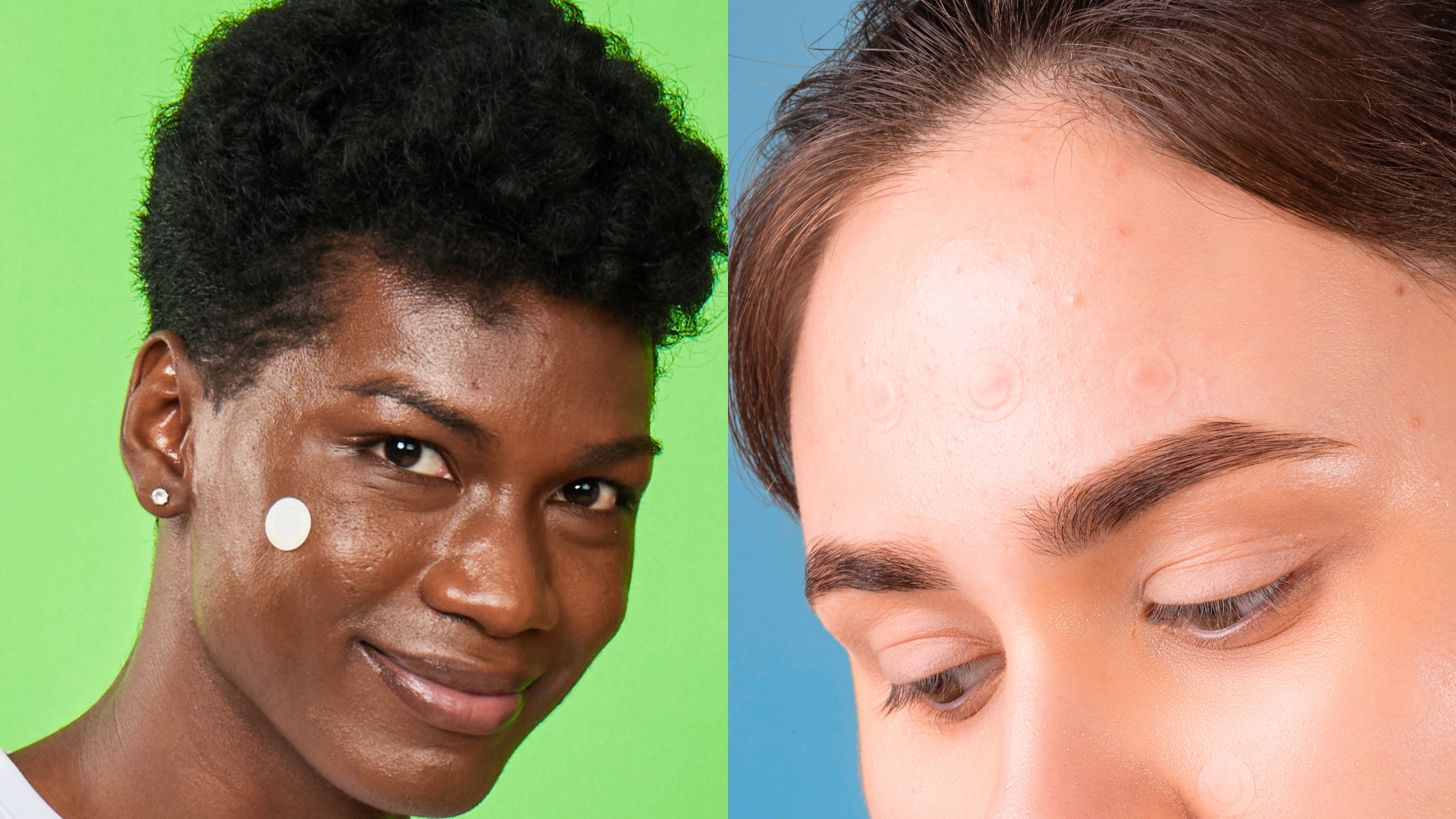 The Differences Between Hydrocolloid and Vector Pimple Patches