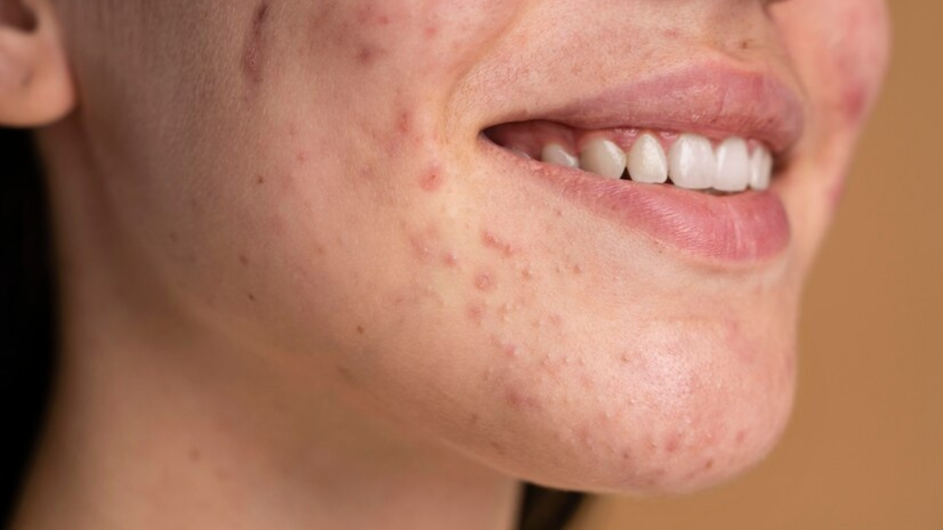 What Caused Your Acne Breakout?