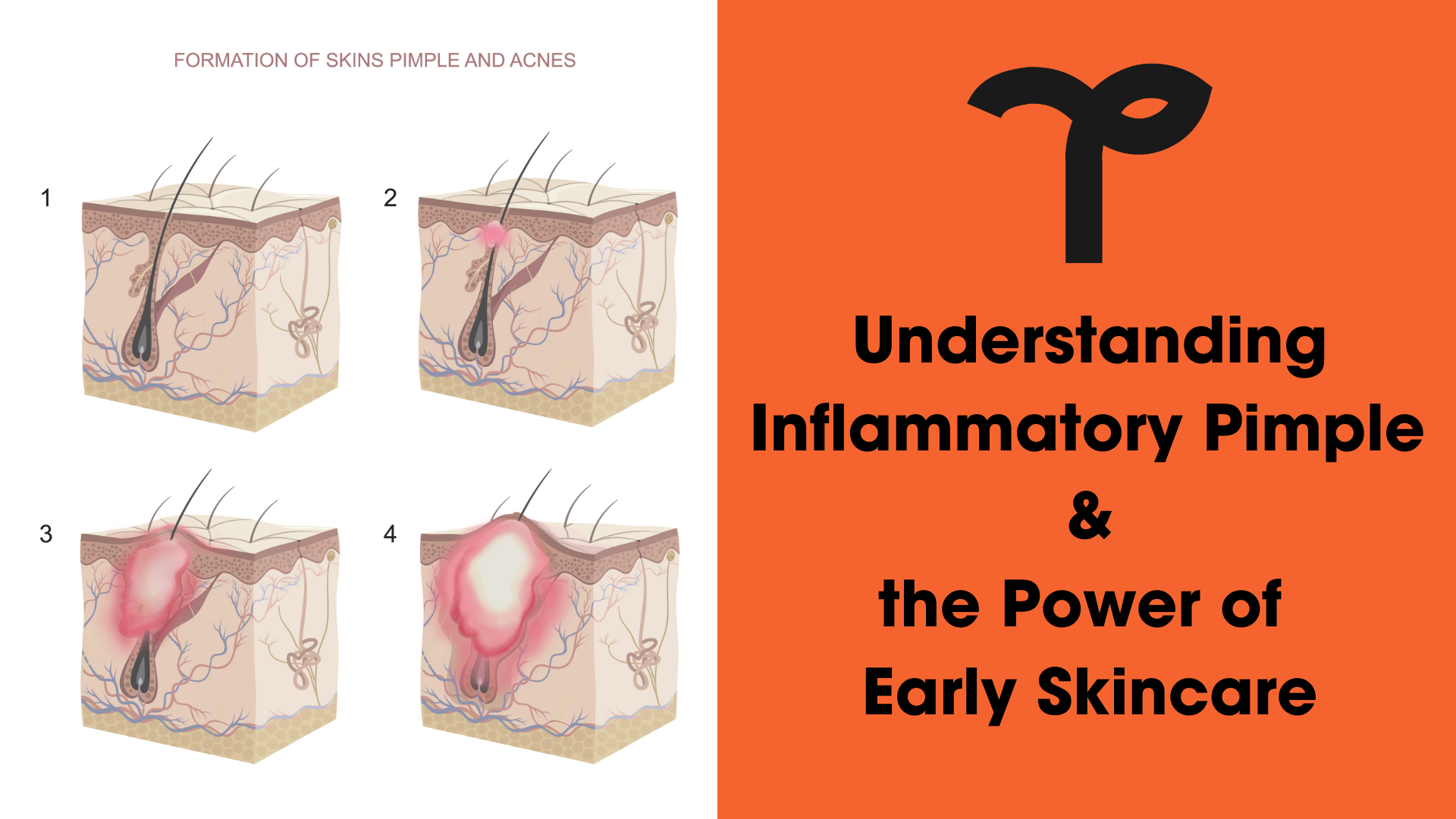 How Pimples Work Understanding Inflammatory Pimple and the Power of Early Skincare